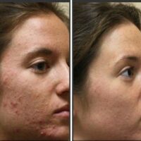 Say Goodbye to Acne: Unveiling the Power of IPL Acne Treatments at Sunnyside Skin Clinic