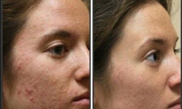 Say Goodbye to Acne: Unveiling the Power of IPL Acne Treatments at Sunnyside Skin Clinic