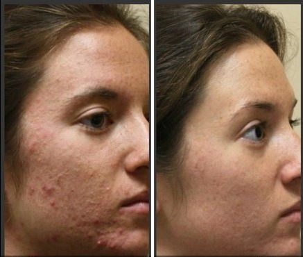 Say Goodbye to Acne: Unveiling the Power of IPL Acne Treatments at Sunnyside Skin Clinic