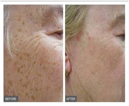 IPL Photorejuvenation Facial.  Look Younger with a non surgical facelift.  Even out your skin tone and pigmentation.  Book a FREE Consultation today.