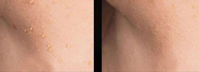 CryoPen™ Skin Tag Removal Treatment before and after