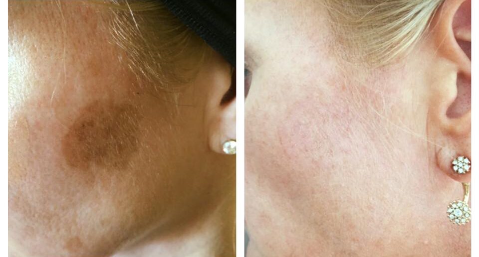 Cryopen-skin-pigmentation-before-after-1-1-e1646144201117.jpg