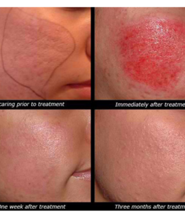 Dermapen Scar Treatment Essex