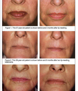 Lip Needling with DermaPen Essex