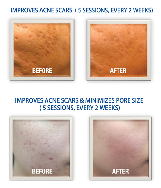 DermanPen Acne Scars Treatment