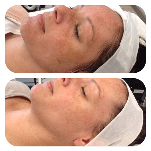 Rejuvenate Your Skin: The Magic of Chemical Peels at Sunnyside Skin Clinic