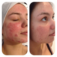 IPL Acne Treatment