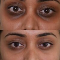 Eyes on Perfection: Treating Dark Circles at Sunnyside Skin Clinic