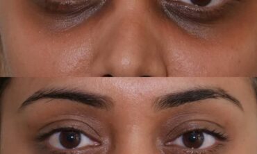 Eyes on Perfection: Treating Dark Circles at Sunnyside Skin Clinic