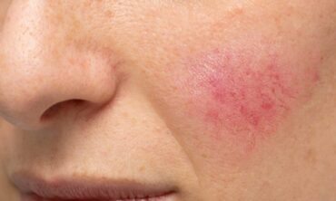 Rosacea