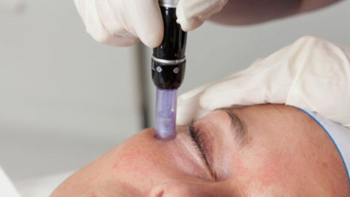 DermaPen™ Treatments: Unlocking the Secret to Healthy, Vibrant Skin