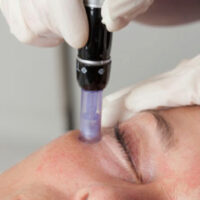 Micro-Needling