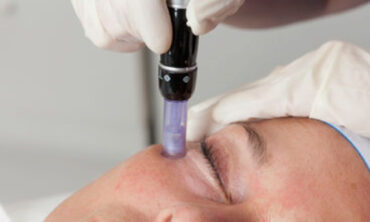 DermaPen™ Treatments: Unlocking the Secret to Healthy, Vibrant Skin