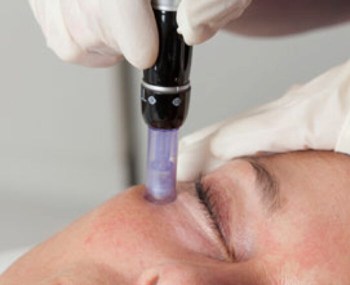 DermaPen™ Treatments: Unlocking the Secret to Healthy, Vibrant Skin