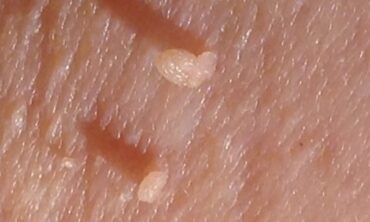 Skin tags