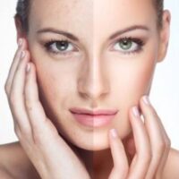 IPL Photorejuvenation Facial