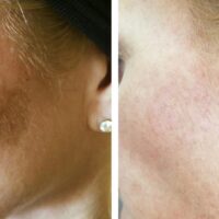 IPL Pigmentation Treatment