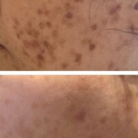 Me Line Melasma and Hyperpigmentation Treatment